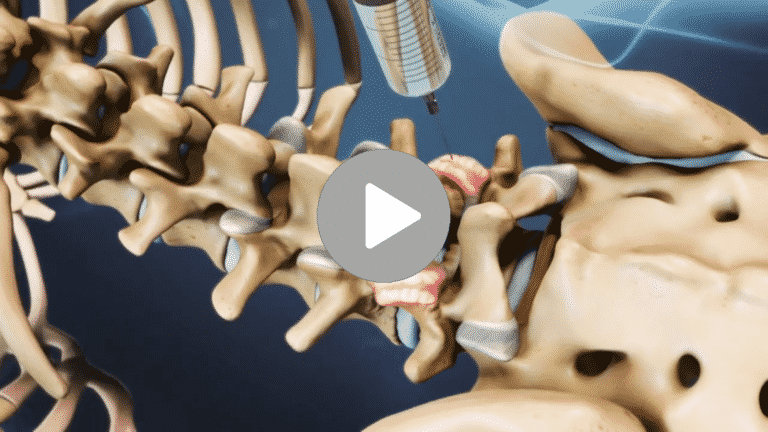 Facet joint injection video