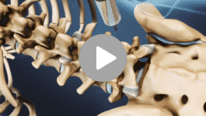 Facet joint injections video