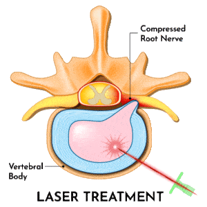 Herniated disc laser gif
