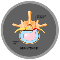 Herniated disc icon