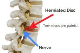 Annular Tear Pain In The Back | AllSpine