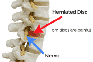 Why You May Have One Sided Back Pain - Atlanta, GA - Spine Surgery