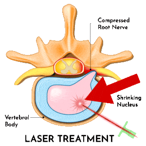 Laser spine treatment