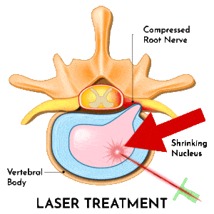 Common Herniated Disc Procedures