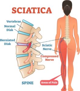 Sciatica Pain Relief - Take pressure off the sciatic nerve