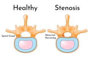 Spinal stenosis sciatica pain