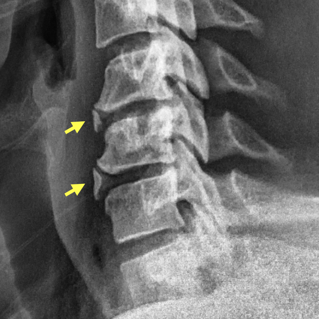 Bone Spur Spine