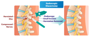 Endoscopic discectomy
