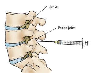 Facet joint injections