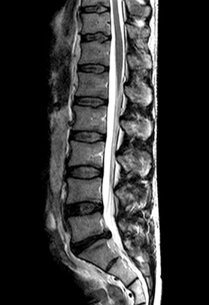 Herniated disc MRI | AllSpine