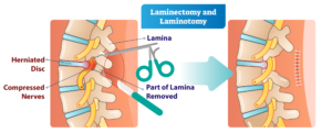 Laminectomy laminotomy