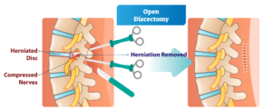 Open discectomy