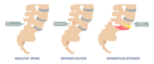 Spondylosis treatment