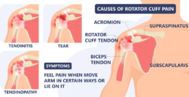 Shoulder Pain Relief | Cortisone Shots | Allspine Surgery Centers