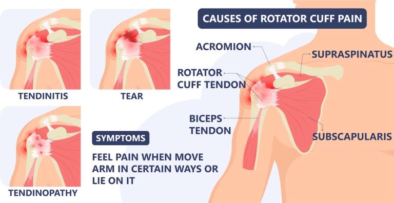 shoulder-pain-relief-cortisone-shots-allspine-surgery-centers