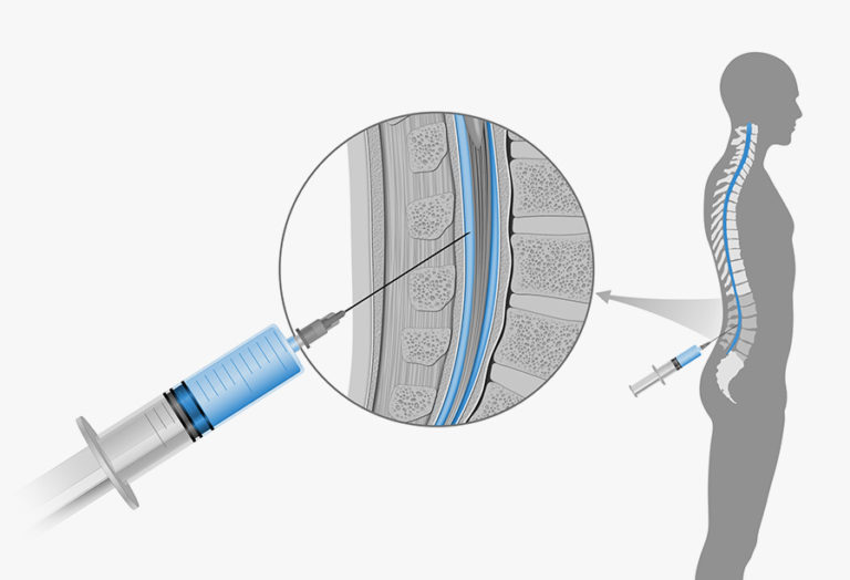 Myelogram Imaging Test | AllSpine