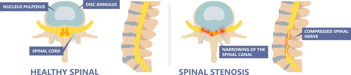 Osteoarthritis spinal stenosis