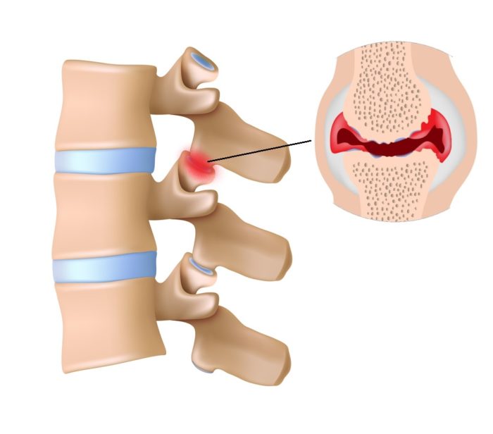 facet-hypertrophy-symptoms-diagnosis-treatment-allspine