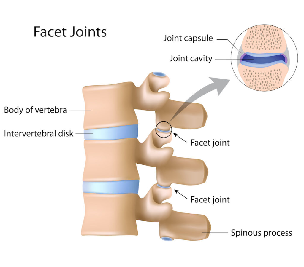 Facet Hypertrophy Symptoms, Diagnosis, Treatment AllSpine