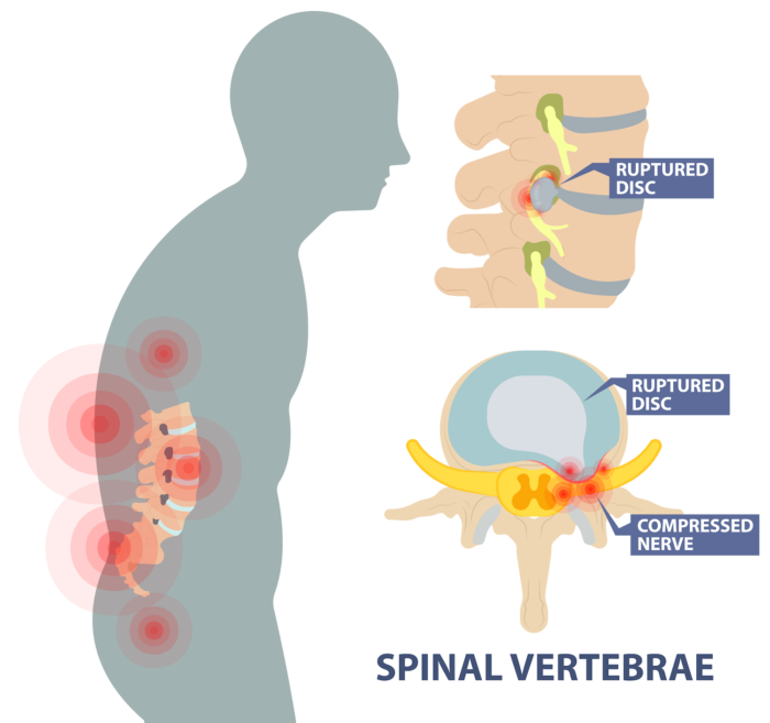 Ruptured Disc Pain & Solutions | AllSpine