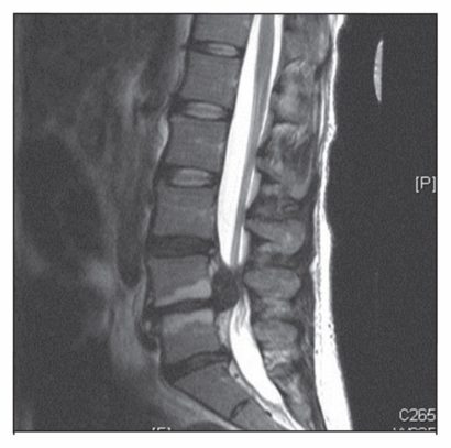 Cauda Equina Syndrome | AllSpine