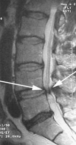 MRI Spinal Stenosis