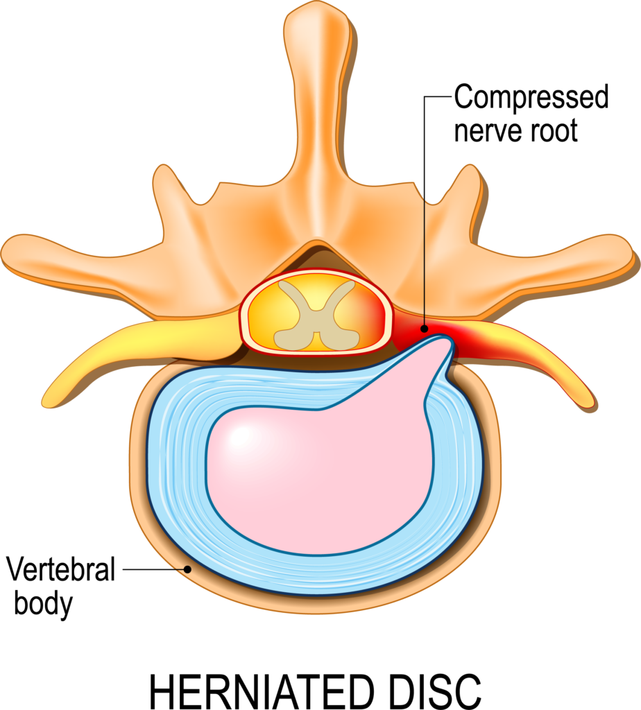 How Long Does a Pinched Nerve Last? AllSpine