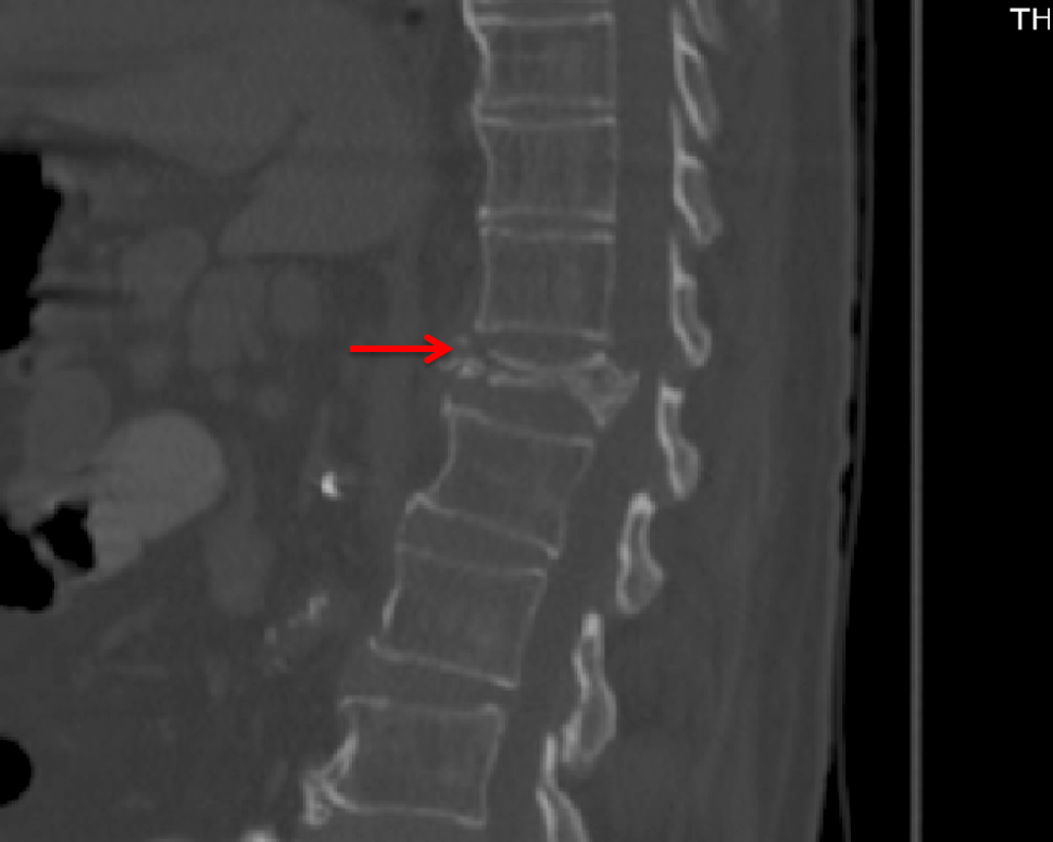 What Is Compression Fracture With Retropulsion at Deborah Noel blog