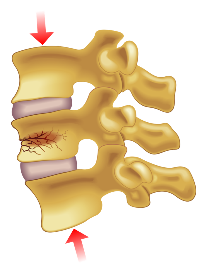 Compression Fractures of the Spine | AllSpine