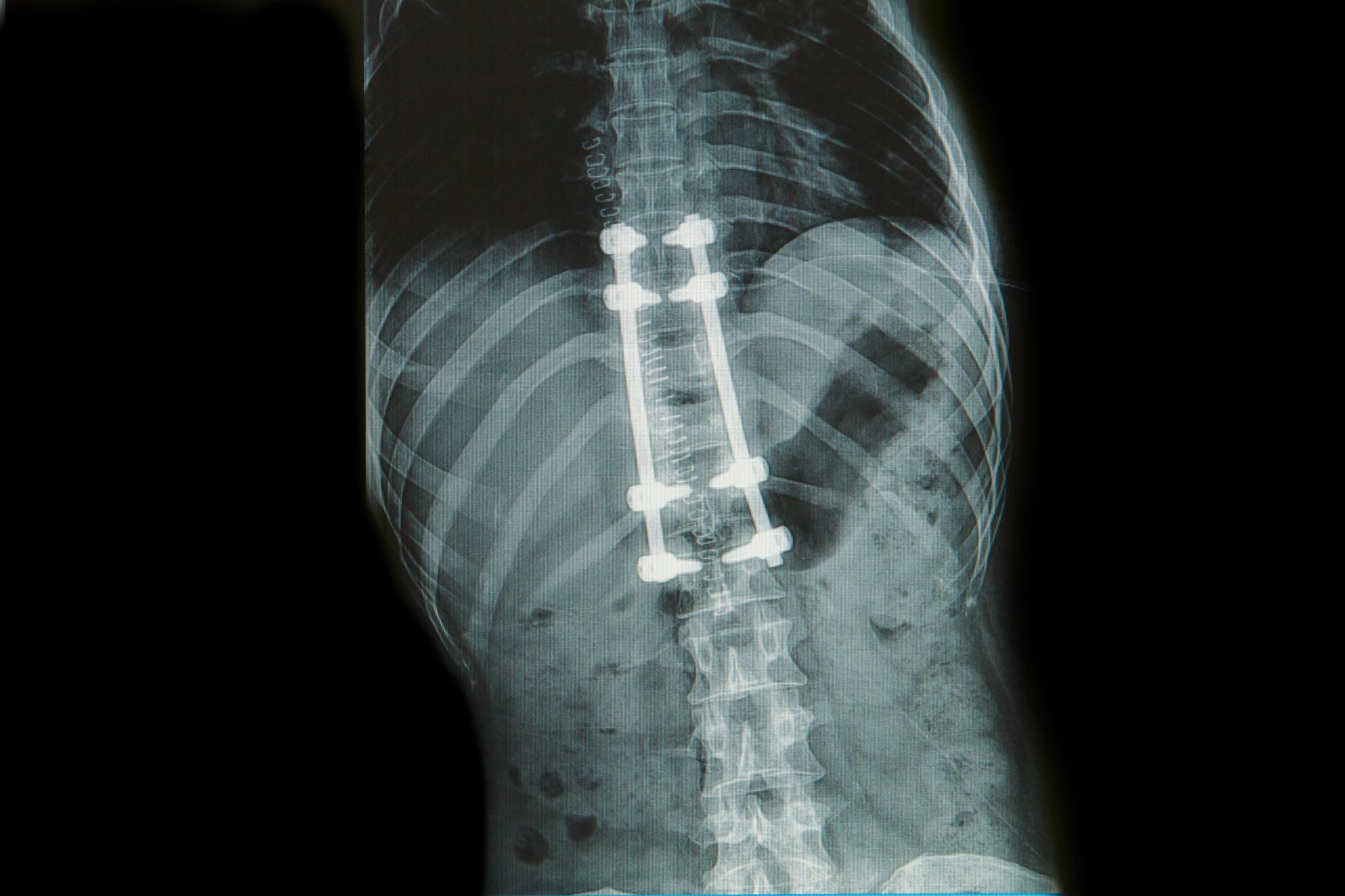 what is spinal fusion surgery | AllSpine
