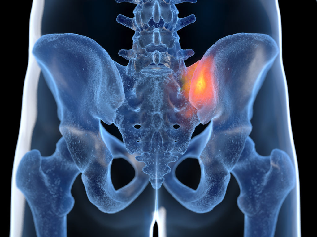 3d rendered illustration of a painful sacroiliac joint | AllSpine