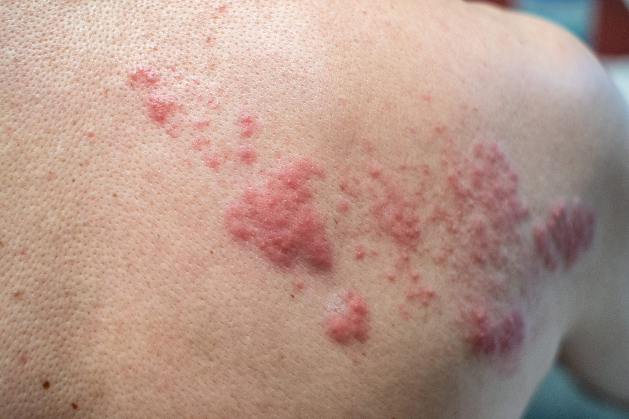 rash on someone's skin
