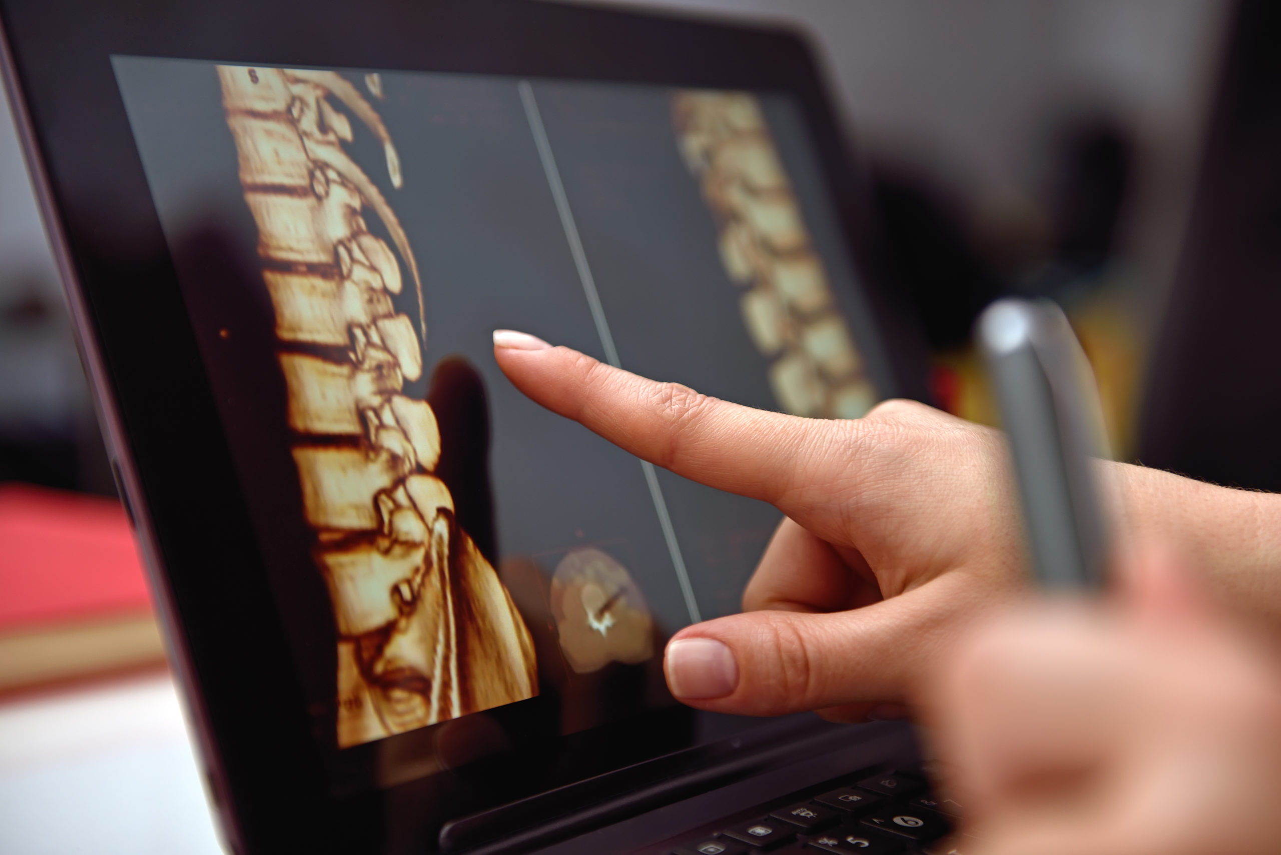what is laser spine surgery?