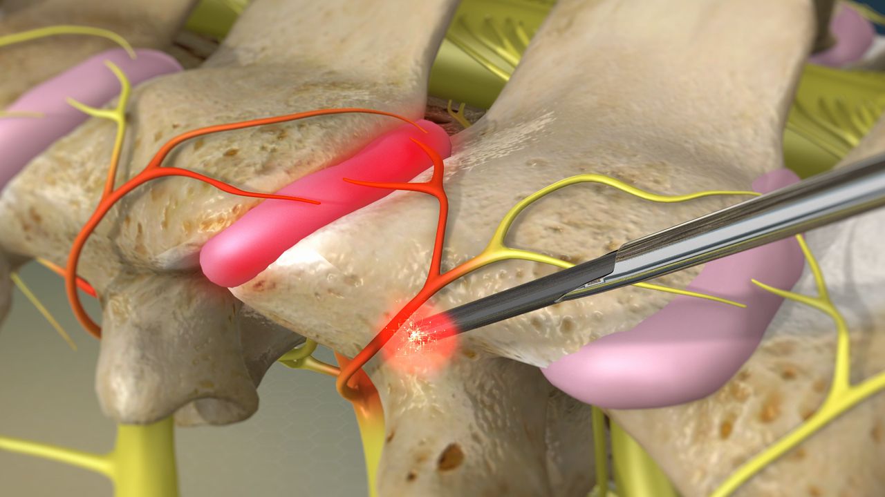 Radiofrequency ablation procedure