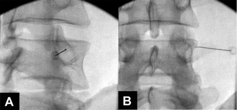 Medial branch block procedure